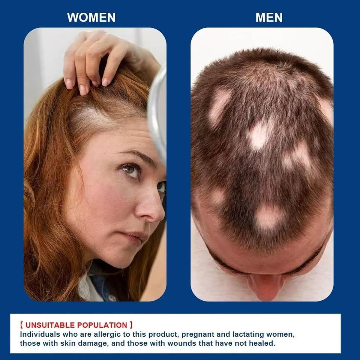 Alopecia Hair Growth Cream
