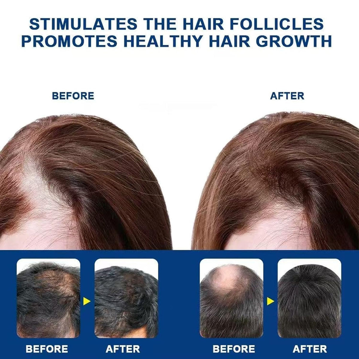 Alopecia Hair Growth Cream