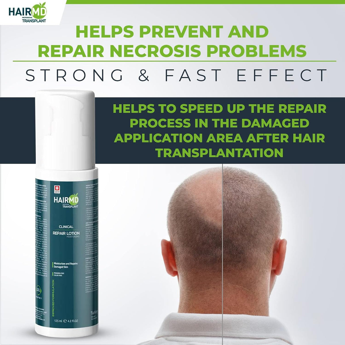 HairMD Transplant Clinical Repair Lotion - 125ml Post-Hair Transplant Formula - Gentle, Nourishing, and Moisturizing on Sensitive Scalp