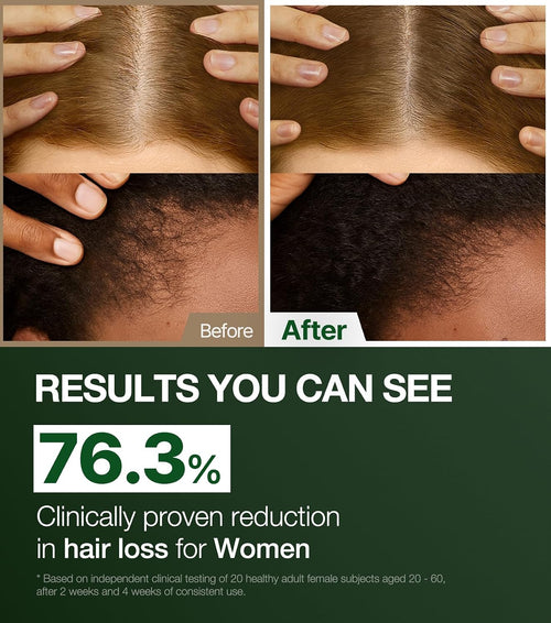Alpha Erguen Hair Loss Tonic for Women, Vegan Scalp Care Serum for Thinning Hair, Weak Hair & Postpartum Hair Care, Pregnancy Safe Formula, 150ml / 5.07 fl oz